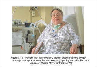 Figure 7.12 – Patient with tracheostomy tube in place receiving oxygen
    through mask placed over the tracheostomy opening and attached to a
                    ventilator. (Ansell Horn/Phototake NYC)
                                                         Copyright ©2009 by Pearson Education, Inc.
Medical Terminology: A Living Language, Fourth Edition       Upper Saddle River, New Jersey 07458
Bonnie F. Fremgen and Suzanne S. Frucht                                          All rights reserved.
 