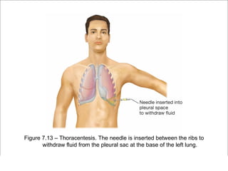 Figure 7.13 – Thoracentesis. The needle is inserted between the ribs to
        withdraw fluid from the pleural sac at the base of the left lung.

                                                         Copyright ©2009 by Pearson Education, Inc.
Medical Terminology: A Living Language, Fourth Edition       Upper Saddle River, New Jersey 07458
Bonnie F. Fremgen and Suzanne S. Frucht                                          All rights reserved.
 