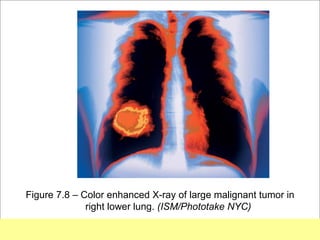Figure 7.8 – Color enhanced X-ray of large malignant tumor in
              right lower lung. (ISM/Phototake NYC)
                                                         Copyright ©2009 by Pearson Education, Inc.
Medical Terminology: A Living Language, Fourth Edition       Upper Saddle River, New Jersey 07458
Bonnie F. Fremgen and Suzanne S. Frucht                                          All rights reserved.
 