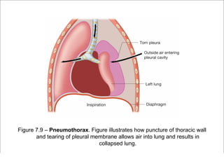 Figure 7.9 – Pneumothorax. Figure illustrates how puncture of thoracic wall
       and tearing of pleural membrane allows air into lung and results in
                                collapsed lung.

                                                          Copyright ©2009 by Pearson Education, Inc.
 Medical Terminology: A Living Language, Fourth Edition       Upper Saddle River, New Jersey 07458
 Bonnie F. Fremgen and Suzanne S. Frucht                                          All rights reserved.
 