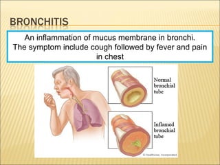An inflammation of mucus membrane in bronchi.
The symptom include cough followed by fever and pain
in chest
 