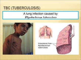 A lung infection caused by
Mycobacterium tuberculosis
 