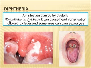 An infection caused by bacteria
Corynebacterium diphteriae. It can cause heart complication
followed by fever and sometimes can cause paralysis
 