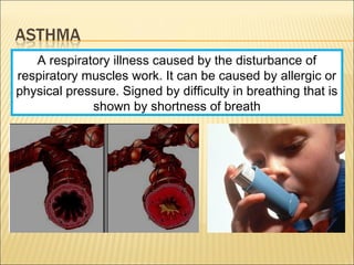 A respiratory illness caused by the disturbance of
respiratory muscles work. It can be caused by allergic or
physical pressure. Signed by difficulty in breathing that is
shown by shortness of breath
 