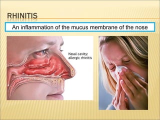 An inflammation of the mucus membrane of the nose
 