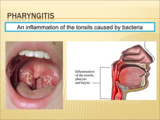 An inflammation of the tonsils caused by bacteria
 