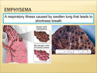 A respiratory illness caused by swollen lung that leads to
shortness breath
 