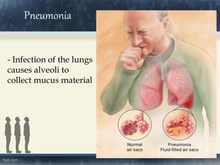 Pneumonia
- Infection of the lungs
causes alveoli to
collect mucus material
 