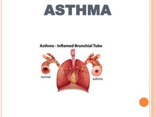 ASTHMA
 