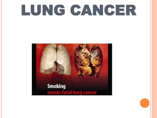 LUNG CANCER
 
