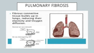 PULMONARY FIBROSIS
 