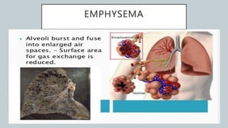 EMPHYSEMA
 