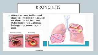 BRONCHITIS
 