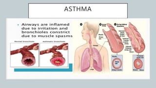 ASTHMA
 