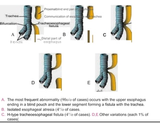 Proximalblind end pan of osophagus
Communication of esophagus with trachea
A
Br
onchi
B
......_Distal part of
esophagus
D
c
E
A. The most frequent abnormality (90o/o of cases) occurs with the upper esophagus
ending in a blind pouch and the lower segment forming a fistula with the trachea.
B. Isolated esophageal atresia (4°/o of cases.
C. H-type tracheoesophageal fistula (4°/o of cases). D,E.Other variations (each 1% of
cases(
 