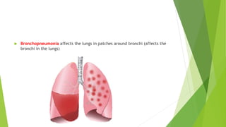  Bronchopneumonia affects the lungs in patches around bronchi (affects the
bronchi in the lungs)
 