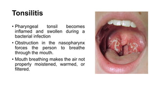 Tonsilitis
• Pharyngeal tonsil becomes
inflamed and swollen during a
bacterial infection
• Obstruction in the nasopharynx
forces the person to breathe
through the mouth.
• Mouth breathing makes the air not
properly moistened, warmed, or
filtered.
 