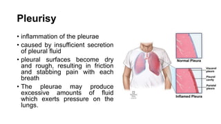 Pleurisy
• inflammation of the pleurae
• caused by insufficient secretion
of pleural fluid
• pleural surfaces become dry
and rough, resulting in friction
and stabbing pain with each
breath
• The pleurae may produce
excessive amounts of fluid
which exerts pressure on the
lungs.
 