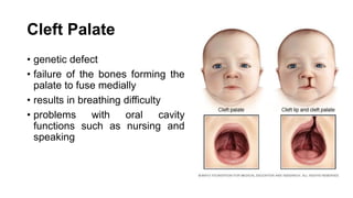Cleft Palate
• genetic defect
• failure of the bones forming the
palate to fuse medially
• results in breathing difficulty
• problems with oral cavity
functions such as nursing and
speaking
 