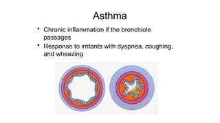 Asthma
• Chronic inflammation if the bronchiole
passages
• Response to irritants with dyspnea, coughing,
and wheezing
 