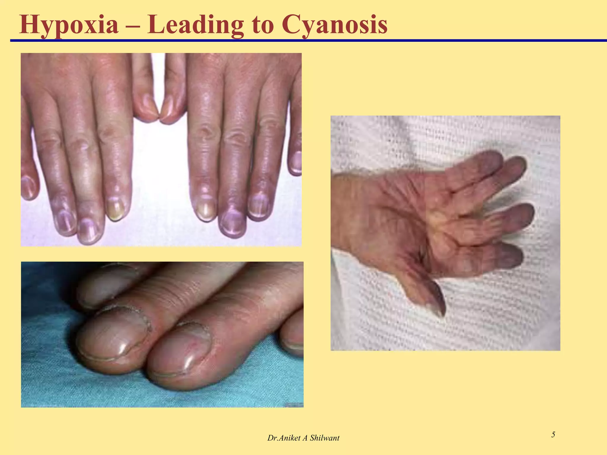Dr.Aniket A Shilwant 5
Hypoxia – Leading to Cyanosis
 