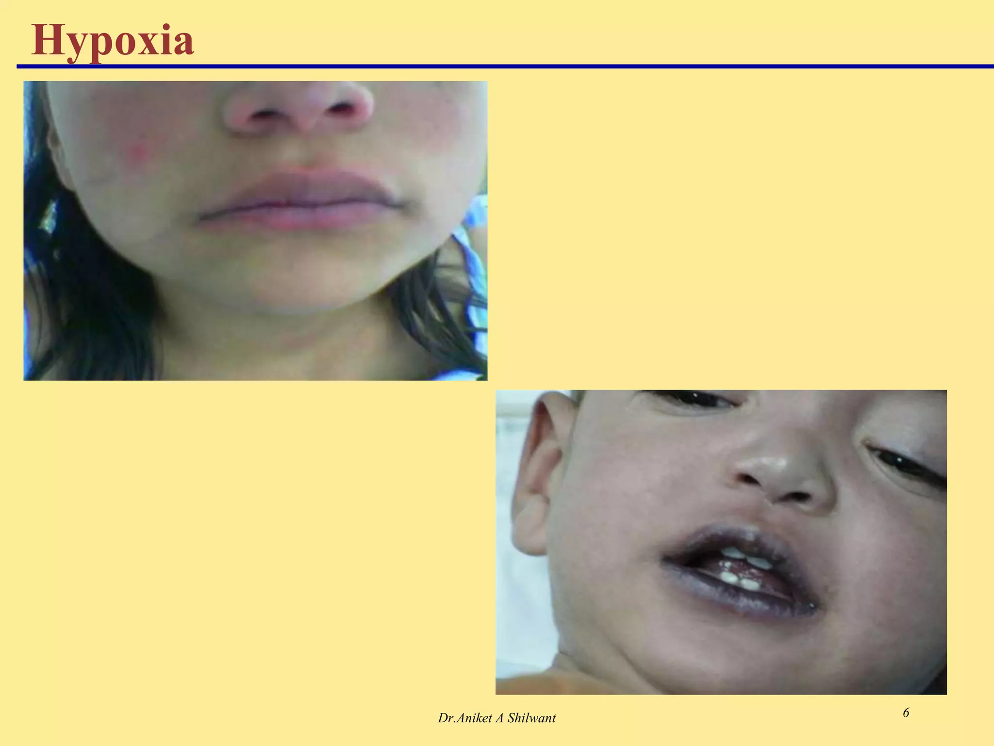 Dr.Aniket A Shilwant 6
Hypoxia
 