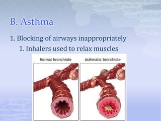 B. Asthma
1. Blocking of airways inappropriately
   1. Inhalers used to relax muscles
 