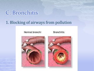 C. Bronchitis
1. Blocking of airways from pollution
 