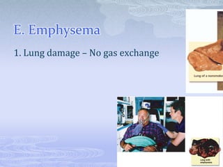 E. Emphysema
1. Lung damage – No gas exchange
 