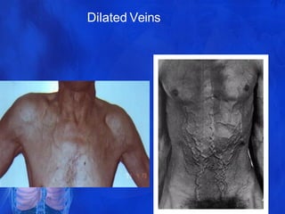 Dilated Veins
40
 