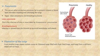  Pneumonia
 This occurs when protective processes fail to prevent inhaled or blood
born microbes reaching and colonizing the lungs.
 Types- lobar pneumonia and bronchopneumonia
Lobar pneumonia
This is the infection of one or more lobes by Streptococcus pneumoniae .
Bronchopneumonia
Infection is spread from the bronchi to terminal bronchioles and alveoli.
 Floatation of the lungs
Fresh healthy lungs always contain some air. Diseased lungs filled with fluid, fetal lungs, and lungs from a still born
infant will not float.
 