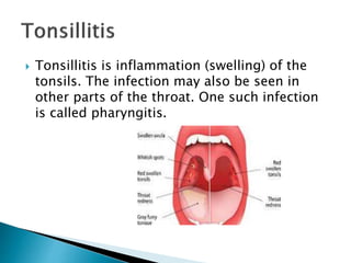  Tonsillitis is inflammation (swelling) of the
tonsils. The infection may also be seen in
other parts of the throat. One such infection
is called pharyngitis.
 