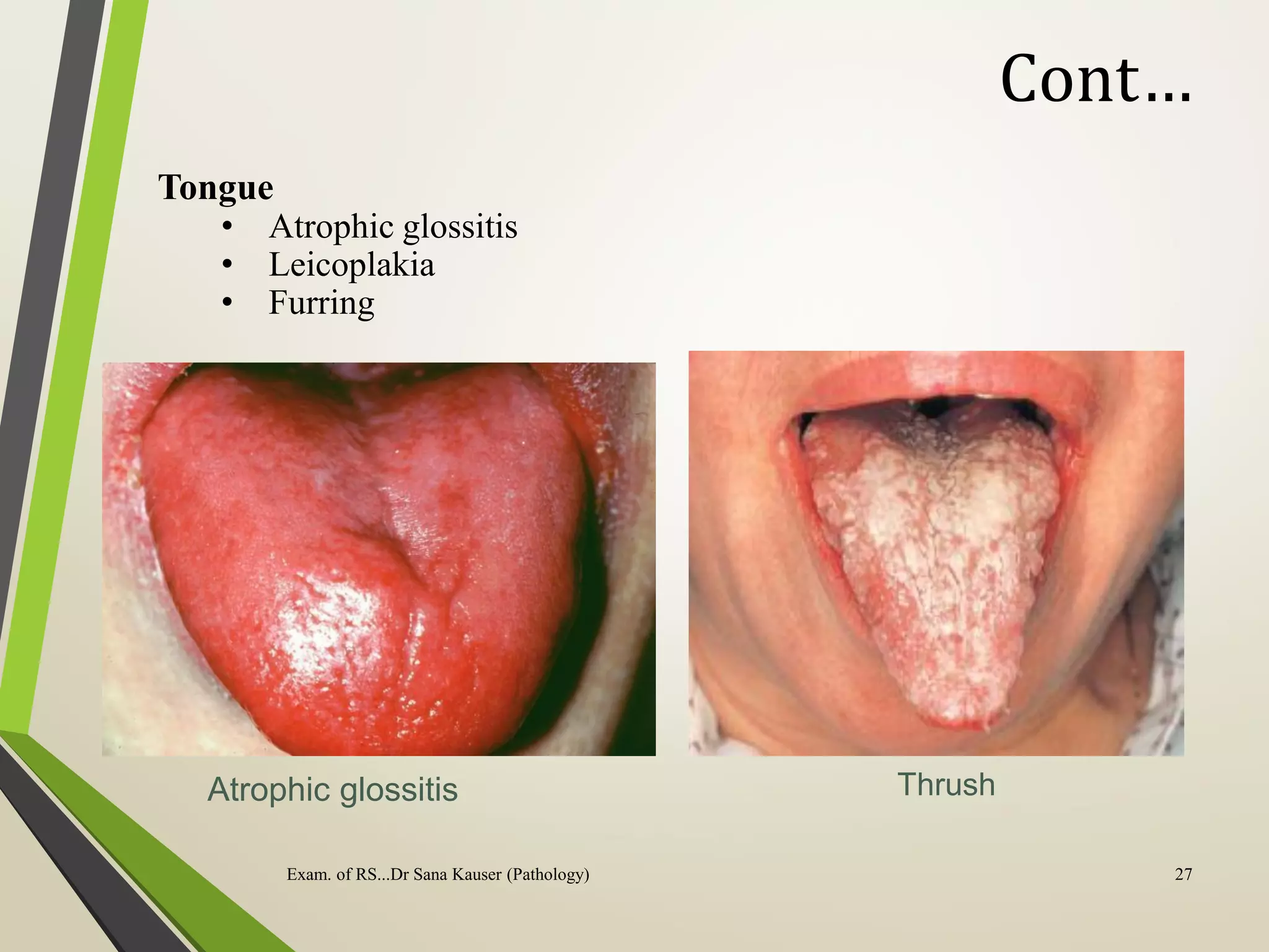Atrophic glossitis Thrush
Tongue
• Atrophic glossitis
• Leicoplakia
• Furring
Cont…
Exam. of RS...Dr Sana Kauser (Pathology) 27
 