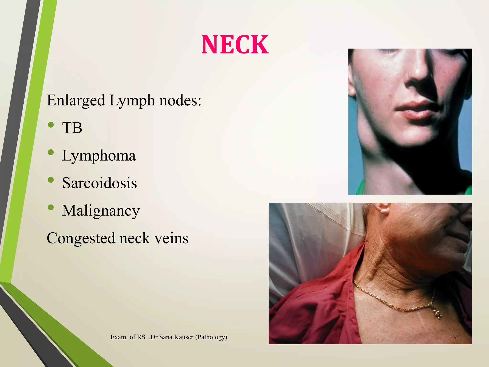 NECK
Enlarged Lymph nodes:
• TB
• Lymphoma
• Sarcoidosis
• Malignancy
Congested neck veins
Exam. of RS...Dr Sana Kauser (Pathology) 31
 