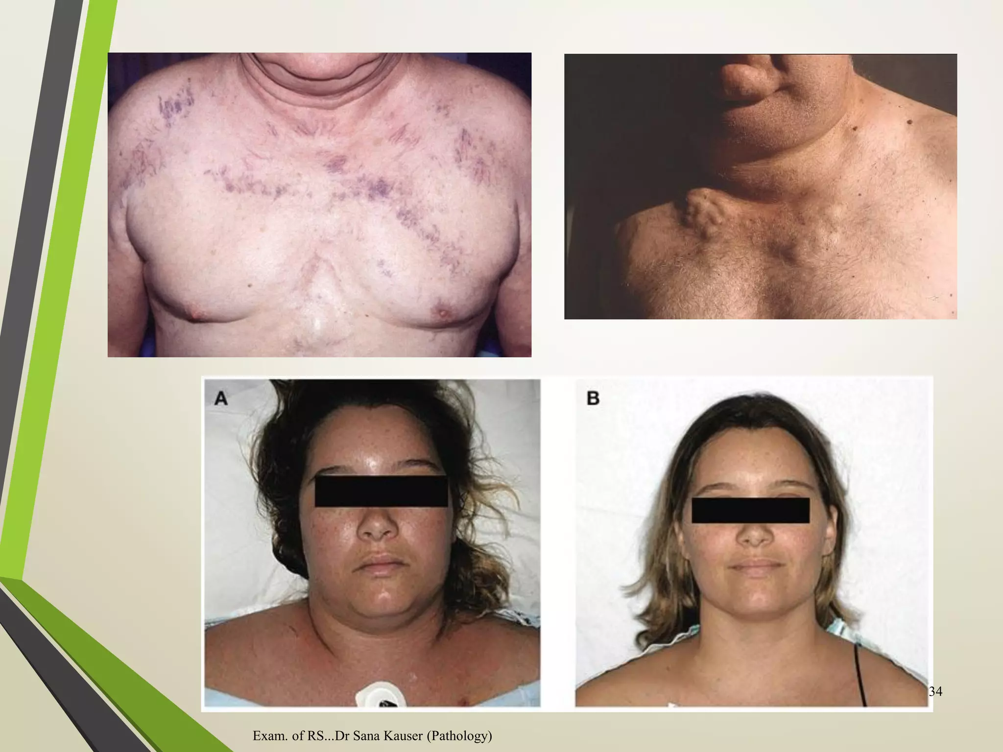 Exam. of RS...Dr Sana Kauser (Pathology)
34
 