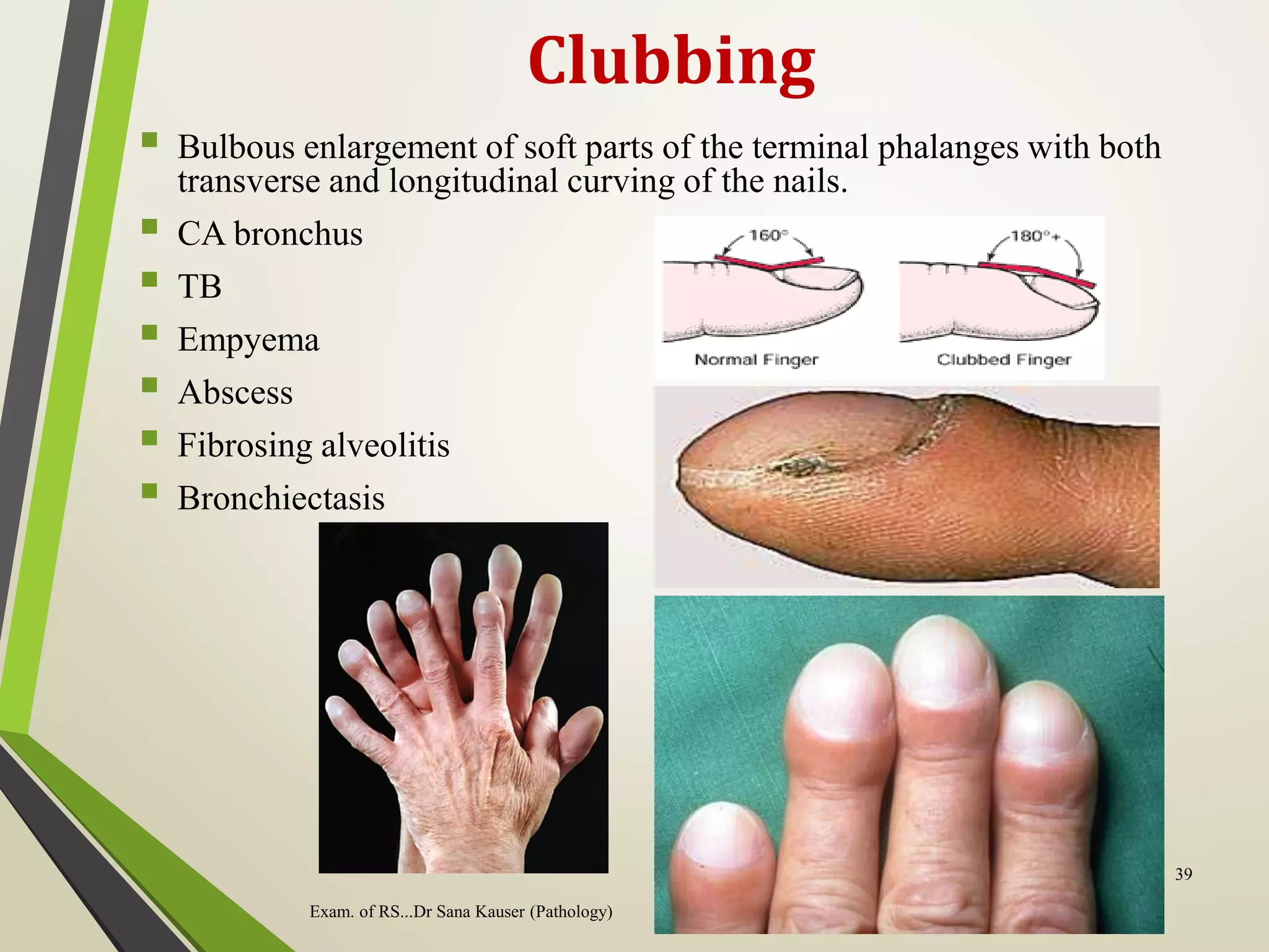 Clubbing
 Bulbous enlargement of soft parts of the terminal phalanges with both
transverse and longitudinal curving of the nails.
 CA bronchus
 TB
 Empyema
 Abscess
 Fibrosing alveolitis
 Bronchiectasis
Exam. of RS...Dr Sana Kauser (Pathology)
39
 