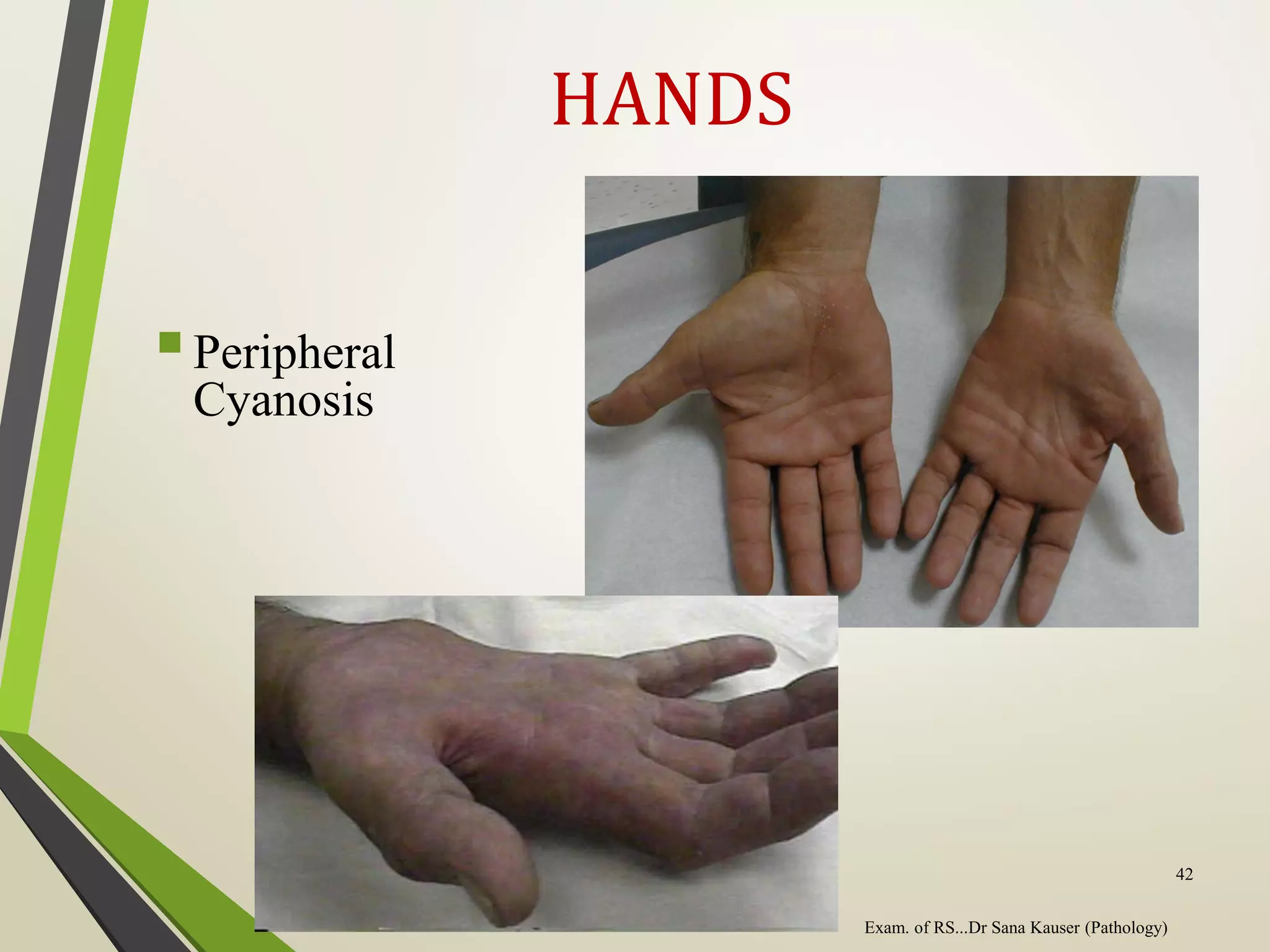 HANDS
Peripheral
Cyanosis
Exam. of RS...Dr Sana Kauser (Pathology)
42
 