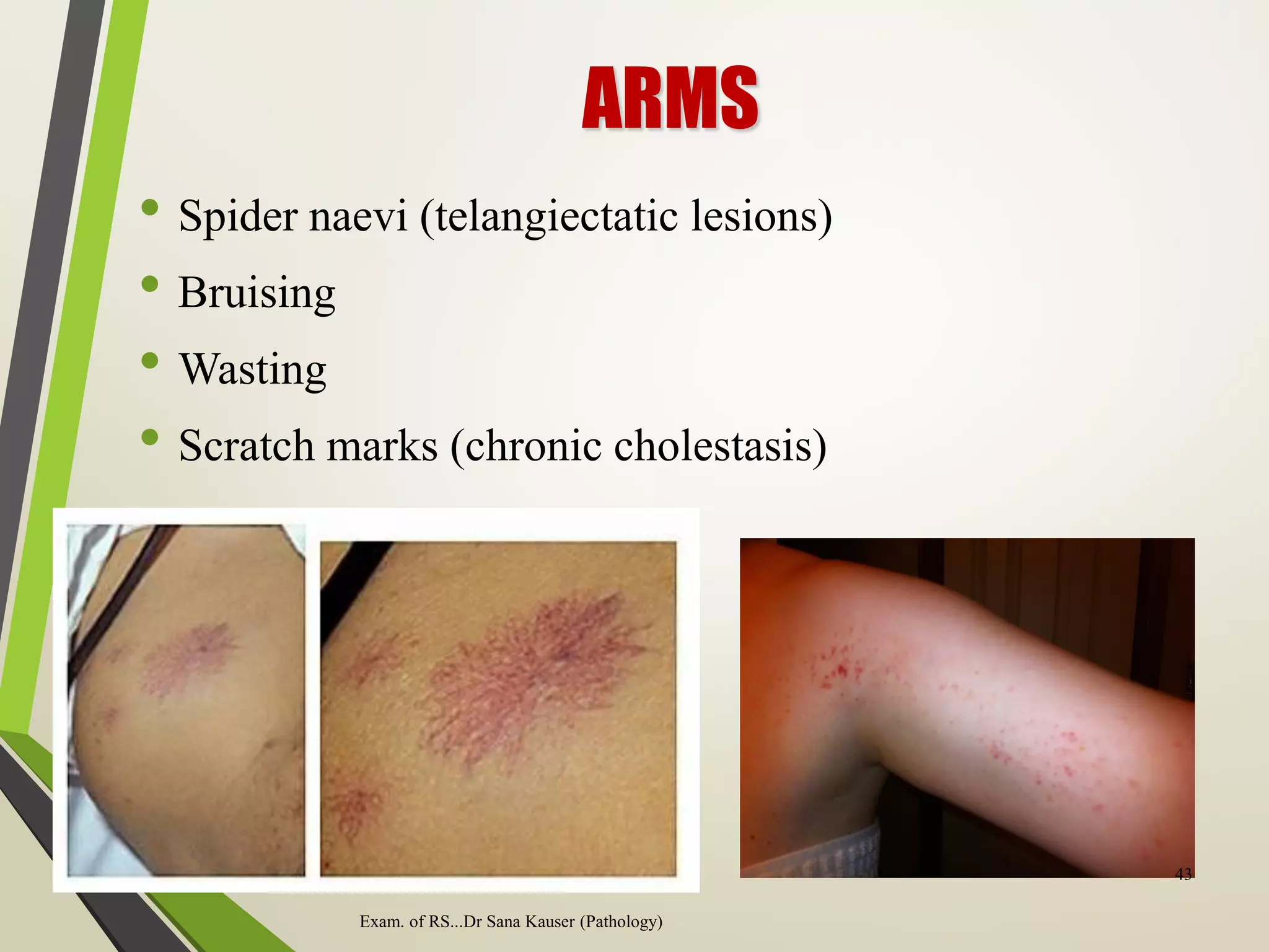 ARMS
• Spider naevi (telangiectatic lesions)
• Bruising
• Wasting
• Scratch marks (chronic cholestasis)
Exam. of RS...Dr Sana Kauser (Pathology)
43
 