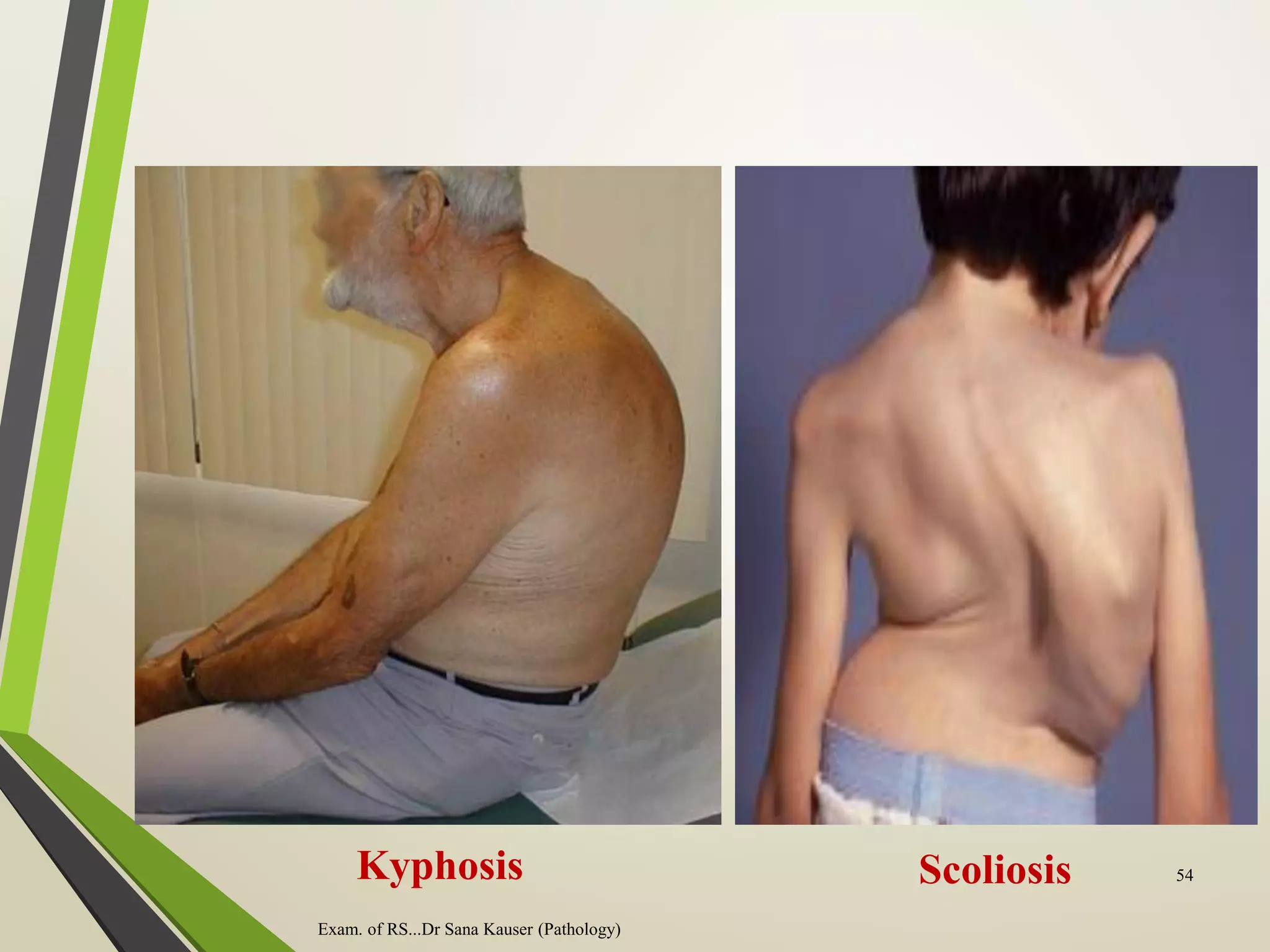Kyphosis Scoliosis
Exam. of RS...Dr Sana Kauser (Pathology)
54
 