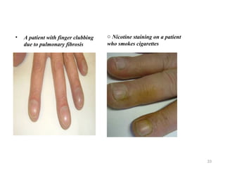 • A patient with finger clubbing
due to pulmonary fibrosis
33
o Nicotine staining on a patient
who smokes cigarettes
 