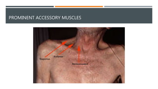 Respiratory system examination | PPTX