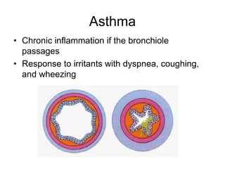 Asthma
• Chronic inflammation if the bronchiole
passages
• Response to irritants with dyspnea, coughing,
and wheezing
 
