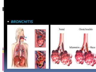 Respiratory tract infections | PPTX