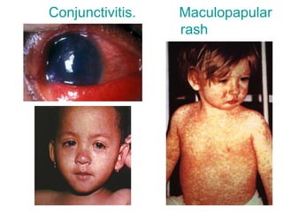 Respiratory viruses infections in children | PPT