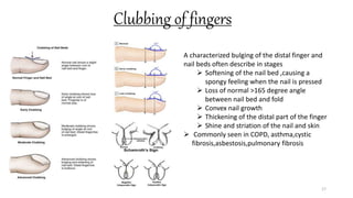 Clubbing of fingers
17
A characterized bulging of the distal finger and
nail beds often describe in stages
 Softening of the nail bed ,causing a
spongy feeling when the nail is pressed
 Loss of normal >165 degree angle
between nail bed and fold
 Convex nail growth
 Thickening of the distal part of the finger
 Shine and striation of the nail and skin
 Commonly seen in COPD, asthma,cystic
fibrosis,asbestosis,pulmonary fibrosis
 
