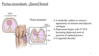 Pectus excavatum –funnel breast
35
A markedly sunken or concave
appearance of sternum and adjacent
cartilages
Depression begins with 2nd ICS
becoming depressed most at
junction of xiphoid process
Congenital disorder
 