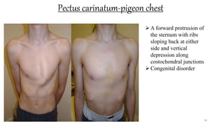 Pectus carinatum-pigeon chest
36
A forward protrusion of
the sternum with ribs
sloping back at either
side and vertical
depression along
costochondral junctions
Congenital disorder
 