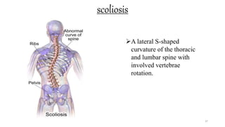 scoliosis
37
A lateral S-shaped
curvature of the thoracic
and lumbar spine with
involved vertebrae
rotation.
 