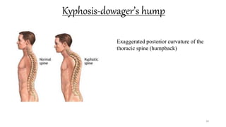 Kyphosis-dowager’s hump
38
Exaggerated posterior curvature of the
thoracic spine (humpback)
 