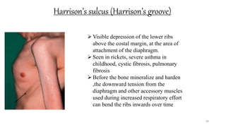 Harrison’s sulcus (Harrison’s groove)
40
Visible depression of the lower ribs
above the costal margin, at the area of
attachment of the diaphragm.
Seen in rickets, severe asthma in
childhood, cystic fibrosis, pulmonary
fibrosis
Before the bone mineralize and harden
,the downward tension from the
diaphragm and other accessory muscles
used during increased respiratory effort
can bend the ribs inwards over time
 